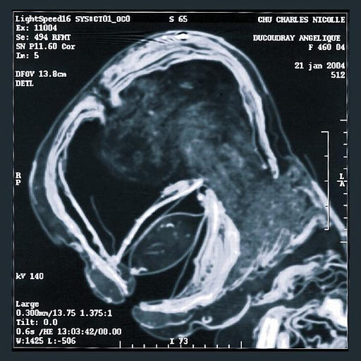 Mannequin d'accouchement (ensemble), foetus (élément d'ensemble)_2