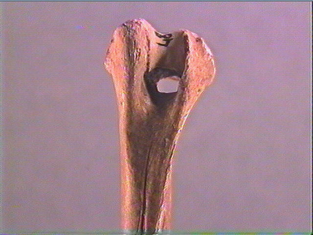Diaphyse (perforé)_3