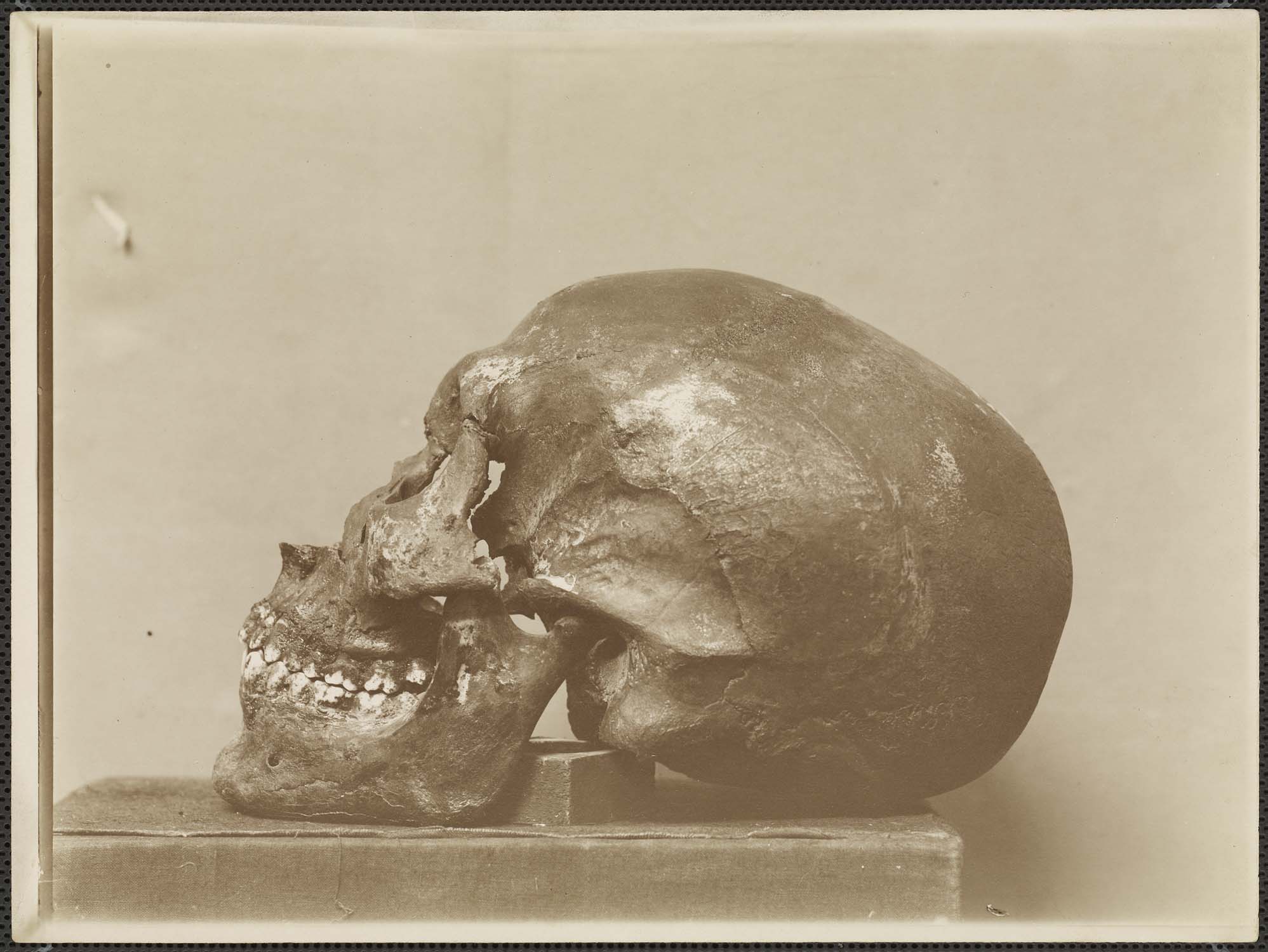 Crâne attribué au roi Aménophis IV (Akhénaton), trouvé dans la Vallée des rois en 1907 (tombe KV 55) : profil gauche