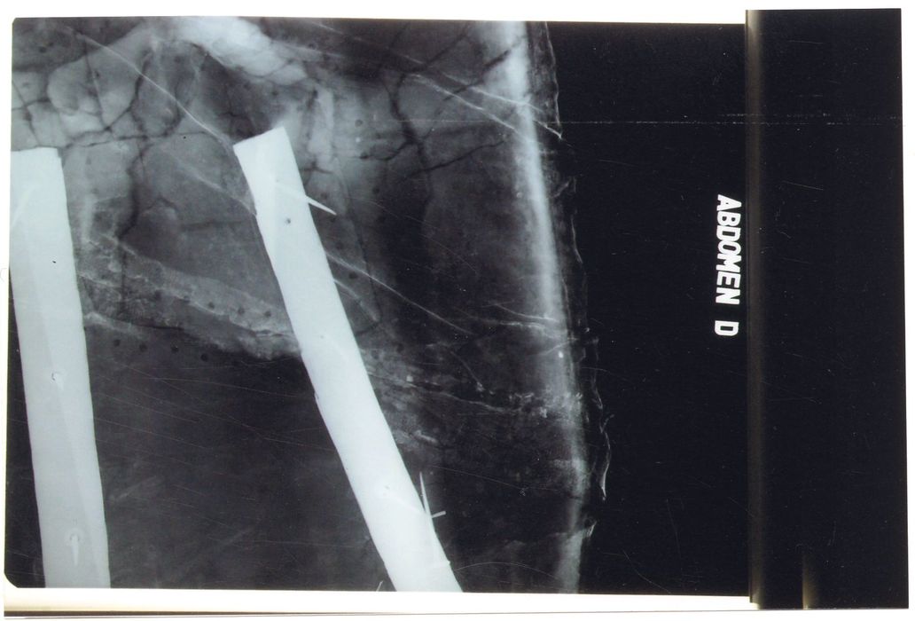 statue : Christ en croix (radiographie), détail abdomen droit