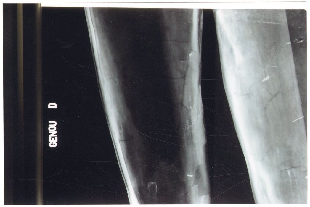 statue : Christ en croix (radiographie), détail genou droit