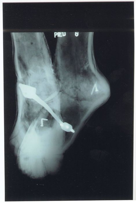 statue : Christ en croix (radiographie), détail pied gauche