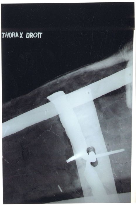 statue : Christ en croix (radiographie), détail thorax droit