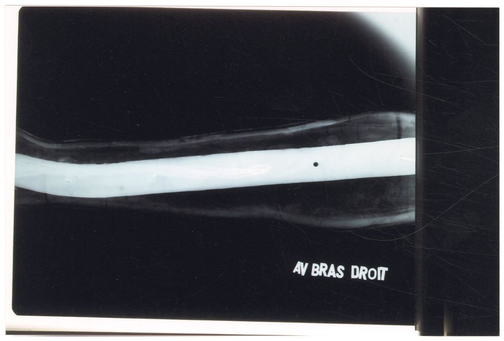 statue : Christ en croix (radiographie), détail avant-bras droit