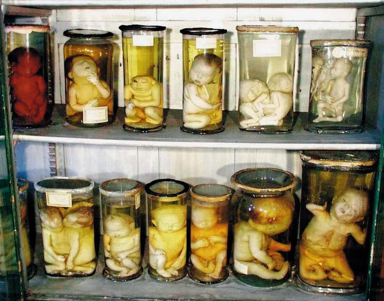 vitrine de tératologie contenant les bocaux de foetus et de nouveaux-nés atteints de malformations congénitales